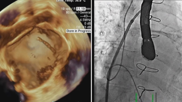 Complex mitral and tricuspid interventions