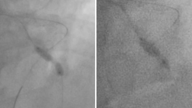 Complex PCI in calcified arteries and more...