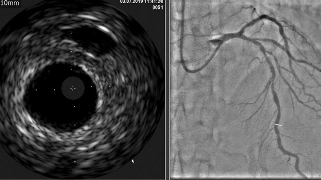 Complex PCI with guidance of IFR and IVUS