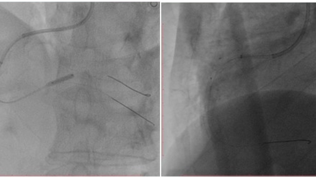 Complex PCI - CTO lesions, acute STEMI & balloon occlusion
