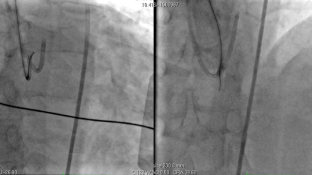 Complex PCI - CTO with difficult collaterals & post-PCI ACS