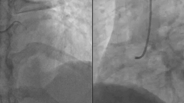 Complex situations during STEMI intervention
