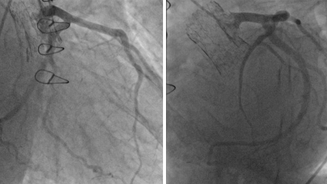 Complex TAVI cases and some non-frequent complications