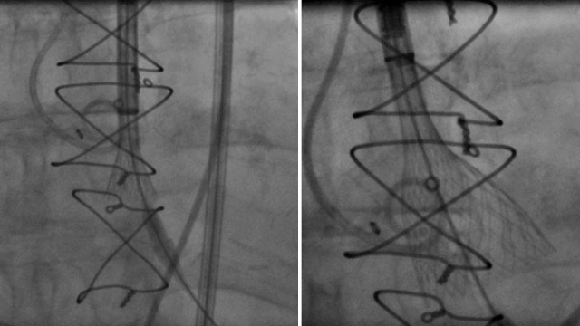 Complex TAVI procedures: BASILICA and ring cracking