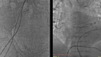 Complicated PCI of heavily calcified stenosis