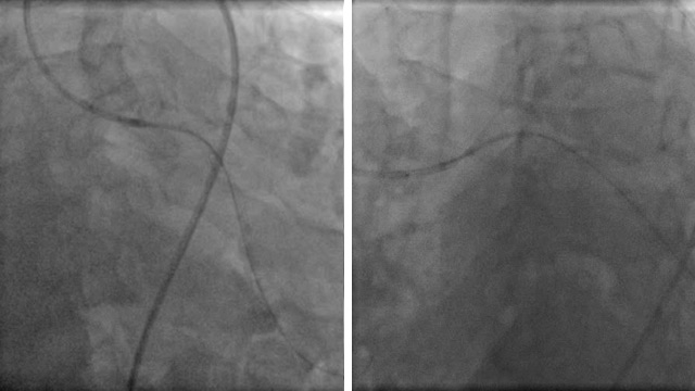 Complications of PCI