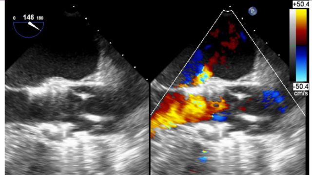 Complications of surgical and transcatheter valve interventions: the case that taught me most