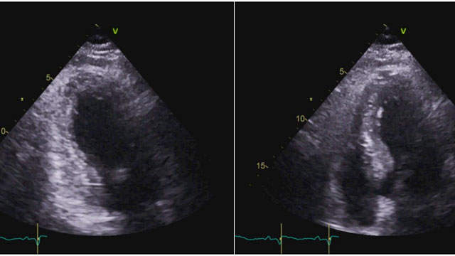 Complications - Embolism, perforation & wire trapping
