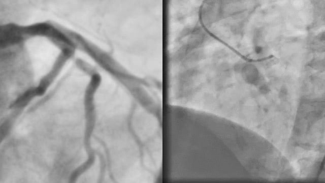 Coronary drug-coated balloons - Why, when and how