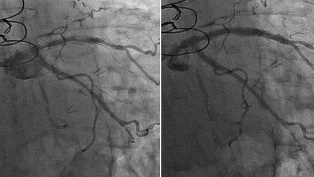 Coronary lithotripsy in complex calcified lesions