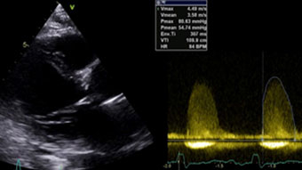 Cracking the rock - The challenge of complex calcified lesions