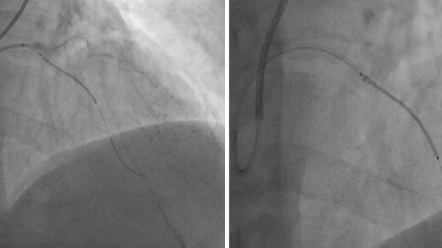 Crushed, dislodged and compressed: features of complicated stent deployment - Part 1