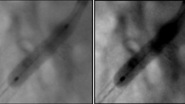 Crushed, dislodged and compressed: features of complicated stent deployment - Part 2