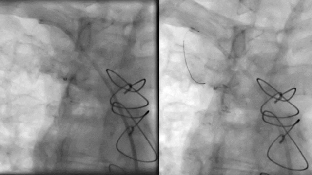 CTO intervention in patients with prior CABG