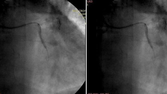 Dealing with coronary perforations in small arteries: coils, glue and more