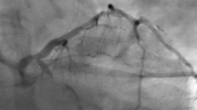 Dealing with difficult side branch access during bifurcation PCI