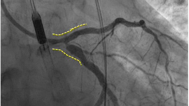 Designing strategies for complex left main PCI