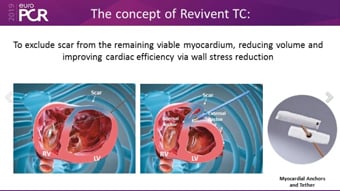 Devices in chronic heart failure: an update for the interventionalist