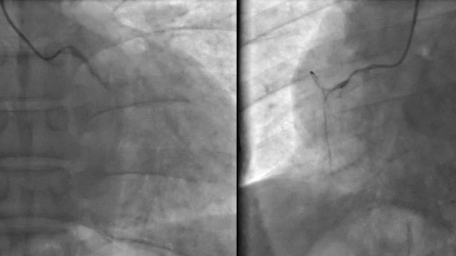 Different approaches to challenging NSTEMI cases