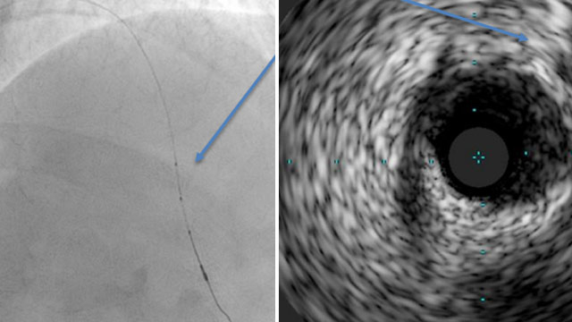 Don't judge a book by its cover: there is more to ACS than thrombus...