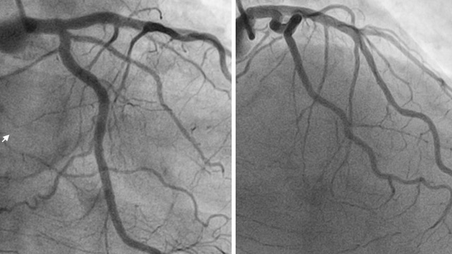 Employing the appropriate strategy in complex CTO treatment