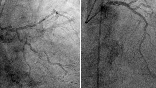 Focus on challenges and complications of left main PCI