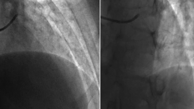 Functional assessment of coronary physiology in special situations