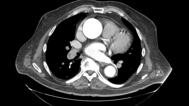 Heart Team 2.0 in action: how to manage complex TAVI procedures