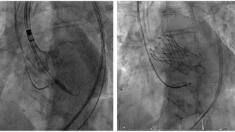 High-bleeding risk PCI patients enrolled in ongoing clinical trials