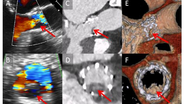 Hot topics in the pharmacologic treatment after TAVI – Current concepts