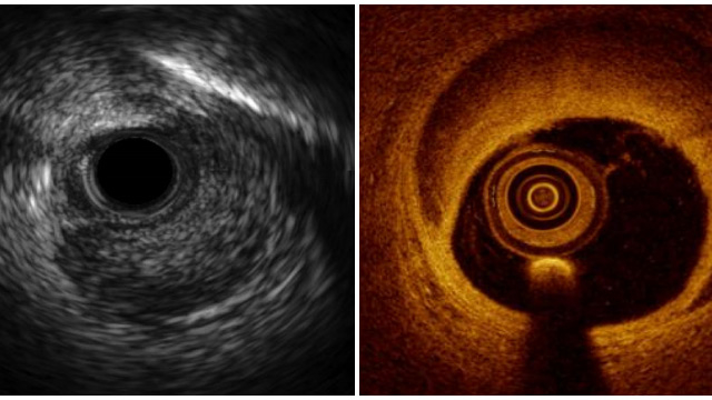 How intracoronary imaging can improve your patients' outcomes
