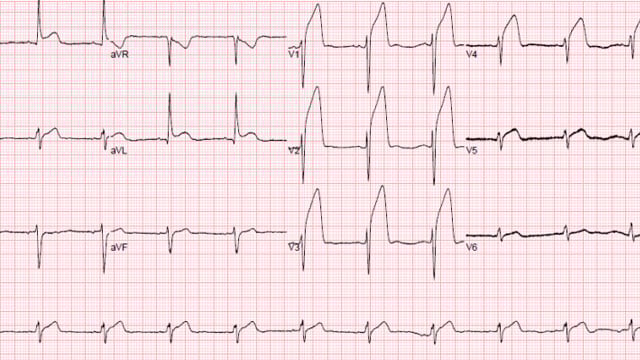 How to deal with thrombus during PCI for STEMI - Part 1
