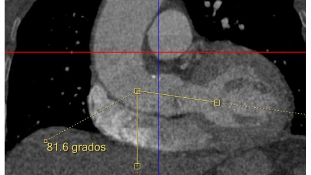 How to deal with unfavorable anatomy: TAVI or surgery?