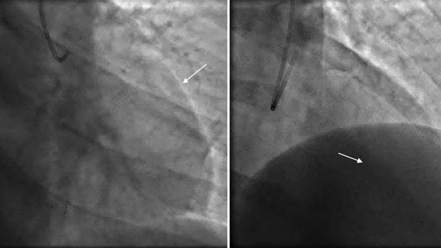 How to fix spontaneous coronary dissections