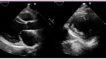 How to manage iatrogenic aortic dissection