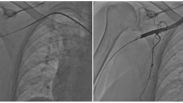 How to manage thrombus during peripheral interventions
