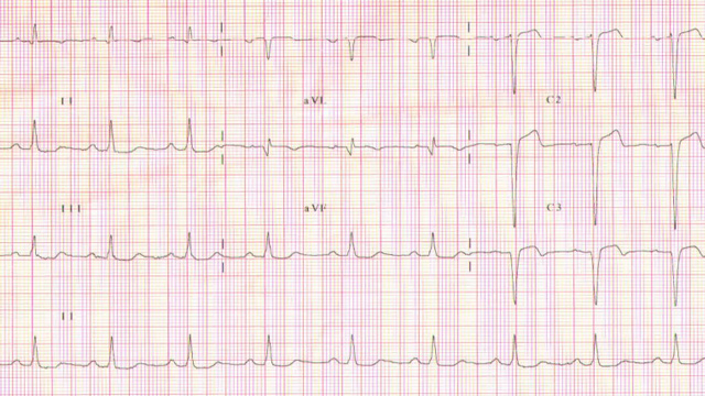 How to treat a patient with challenging STEMI scenarios?