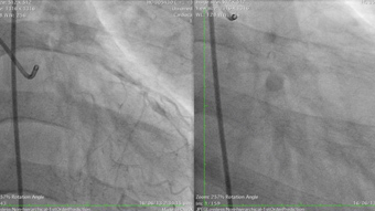 Innovations for the treatment of complex coronary artery lesions from LATAM