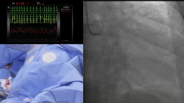 Innovations in complex multivessel disease PCI – SYNTAX II strategy and beyond