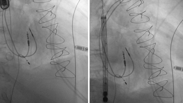 Innovations in mitral and tricuspid interventions