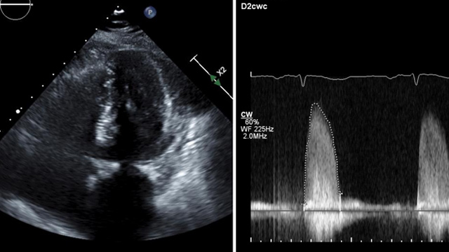 Innovations in TAVI technique and technology to address evolving patient needs