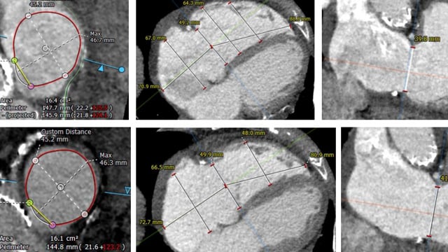 Innovations in transcatheter tricuspid valve intervention