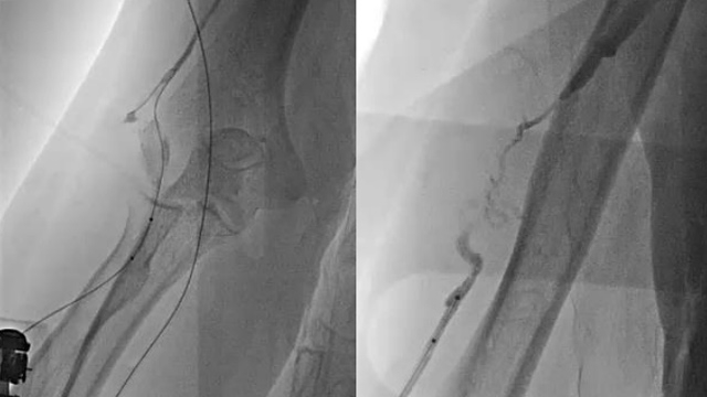 Interactive Case Corner 1 - Thrombosed AVG, bifurcation lesions & diffuse CAD