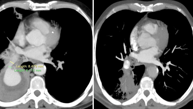 Interactive Case Corner 2 - Rasmussen's aneurysm, recurrent haemoptysis & acute limb ischemia