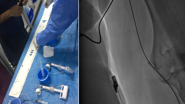 Interactive Case Corner 4 - Wandering stent