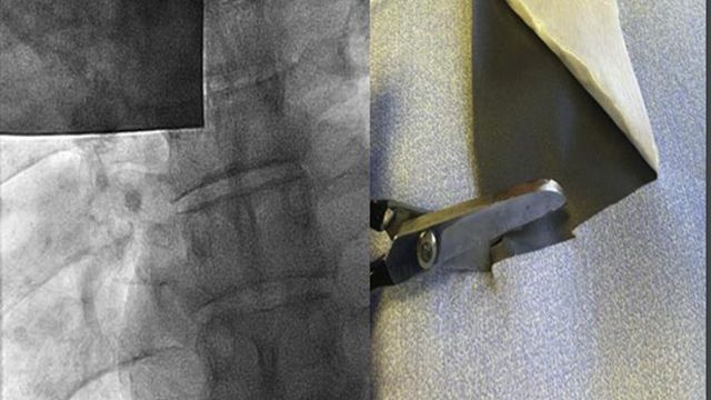 Interactive Case Corner 5 - Coronary CTO & ACS NSTEMI
