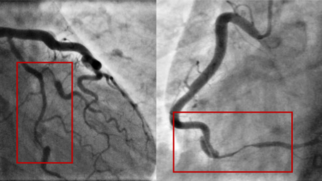 Interactive Case Corner 6 - SCAD, LMS lesions & stent thrombosis
