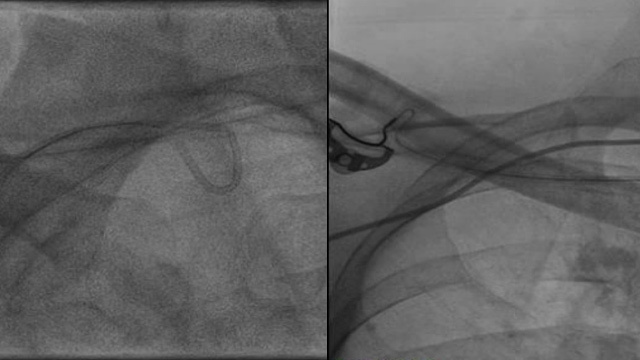 Interactive Case Corner 7 - SVG thrombosis, twisted coronary catheter & stent loss