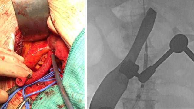 Interactive Case Corner 9 - Complex TAVI & PCI