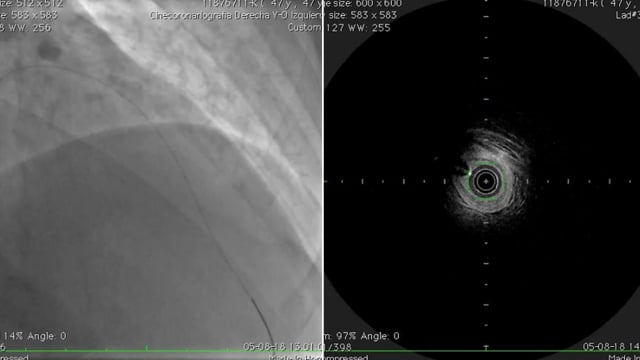 Intracoronary imaging during PCI for ACS: cases where OCT did help... a lot!